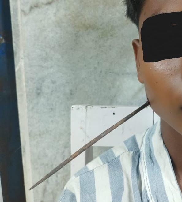 रायपुर : 7 सेंटीमीटर तक चेहरे में घुसा औजार, घायल बालक को जान के जोखिम से बाहर लाया, ENT विभाग के डॉक्टरों ने रचा कीर्तिमान